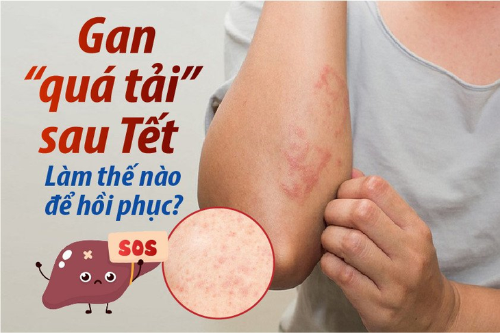 Gan "quá tải" sau Tết – Làm thế nào để hồi phục? - Ảnh 1. Gan "quá tải" sau Tết – Làm thế nào để hồi phục? - Ảnh 1.