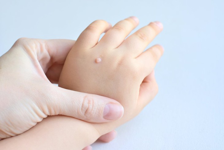 Hạt cơm là bệnh tương đối lành tính, một số trường hợp tổn thương nhỏ, số lượng ít, bệnh nhân khỏe mạnh và hệ miễn dịch tốt có thể tự thoái triển không cần điều trị. Hạt cơm là bệnh tương đối lành tính, một số trường hợp tổn thương nhỏ, số lượng ít, bệnh nhân khỏe mạnh và hệ miễn dịch tốt có thể tự thoái triển không cần điều trị.