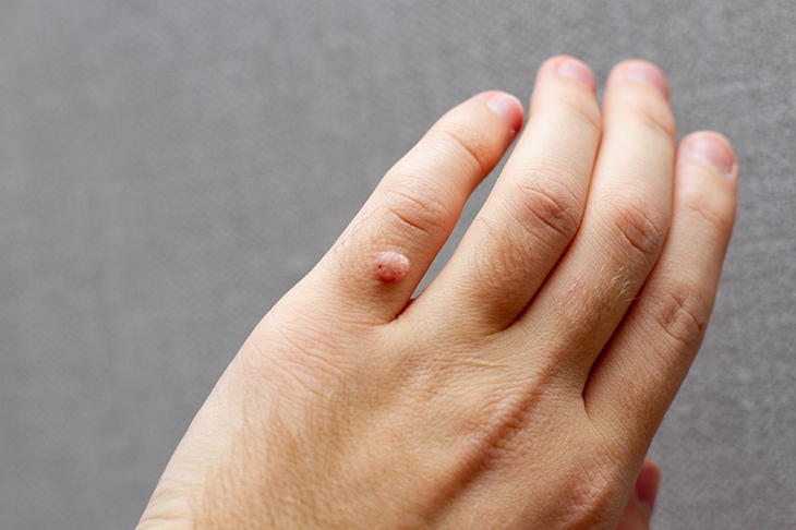 SKĐS - Hạt cơm hay còn gọi là mụn cóc là bệnh da liễu khá phổ biến, gây nên bởi virus HPV (Human Papilloma Virus). – virus gây u nhú ở người. SKĐS - Hạt cơm hay còn gọi là mụn cóc là bệnh da liễu khá phổ biến, gây nên bởi virus HPV (Human Papilloma Virus). – virus gây u nhú ở người.