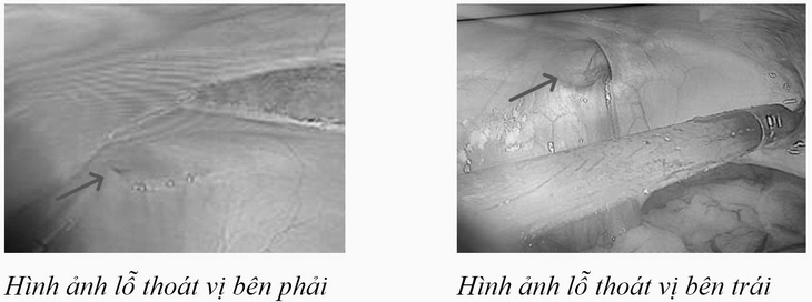 Cực nguy hiểm: Thoát vị bẹn hai bên có thể gây các biến chứng đe dọa tính mạng - Ảnh 1.