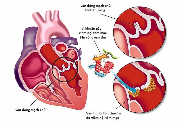 Ngăn ngừa biến chứng viêm nội tâm mạc nhiễm khuẩn - Ảnh 1.