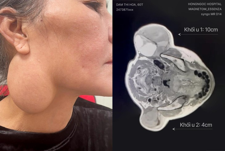 Loại bỏ thành công khối u tuyến nước bọt khổng lồ đeo đẳng người phụ nữ 60 tuổi - Ảnh 1. Loại bỏ thành công khối u tuyến nước bọt khổng lồ đeo đẳng người phụ nữ 60 tuổi - Ảnh 1.