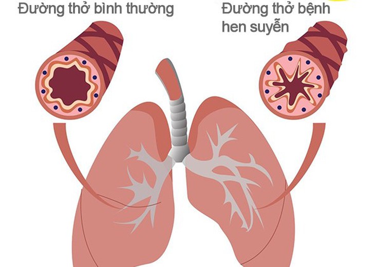 Người bệnh hen phế quản nên chú ý gì khi tập luyện? - Ảnh 1.