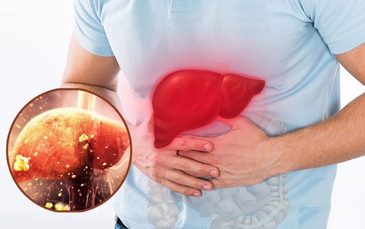 Điểm mặt những thực phẩm tồi tệ nhất cho sức khỏe lá gan