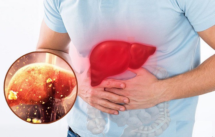 Điểm mặt những thực phẩm tồi tệ nhất cho sức khỏe lá gan  - Ảnh 2.