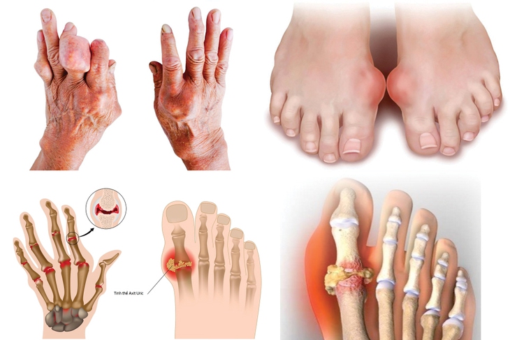 Bệnh gout mạn tính làm gì để kiểm soát bệnh và tránh biến chứng - Ảnh 2.
