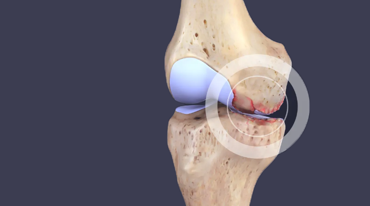 Thoái hóa khớp là gì, có chữa được không? - Ảnh 3.