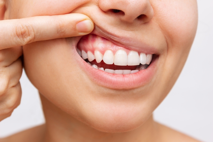 12 loại thực phẩm tốt nhất nên ăn khi bị viêm nướu răng - Ảnh 2.