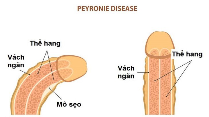 Những biện pháp xử trí đối với dương vật cong - Ảnh 3.