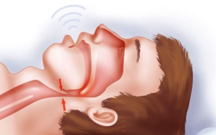 Ngủ ngáy và Hội chứng ngưng thở tắc nghẽn khi ngủ