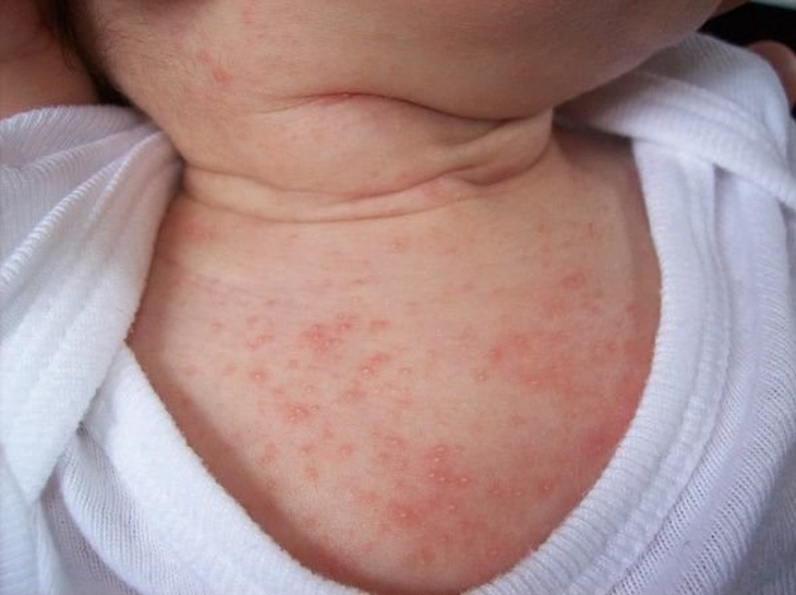 Mách mẹ cách xử lý các vấn đề về da ở trẻ - Ảnh 2.