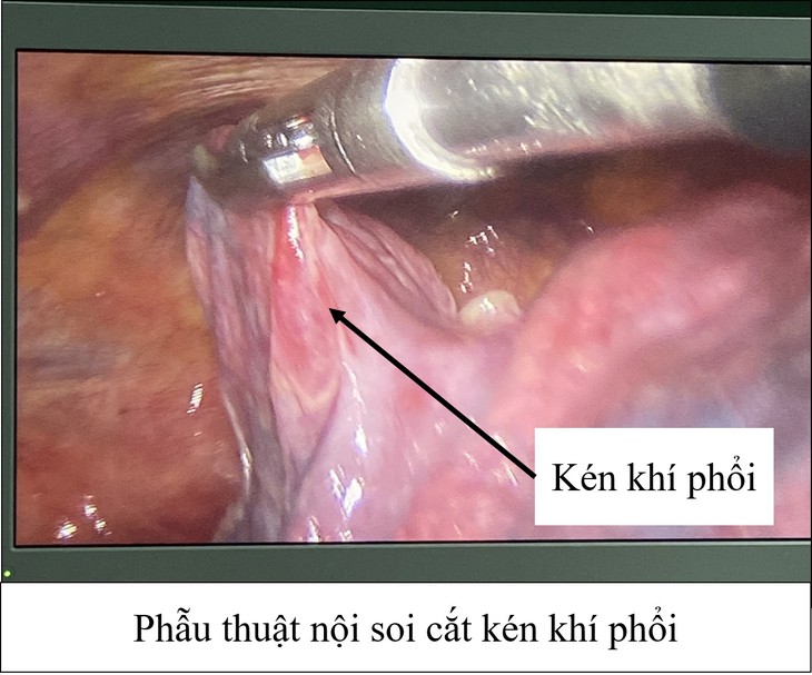 Sốt, ho khạc đờm… cần cảnh giác với kén phổi gây suy hô hấp và 7 bước chăm sóc đường hô hấp đúng - Ảnh 1.