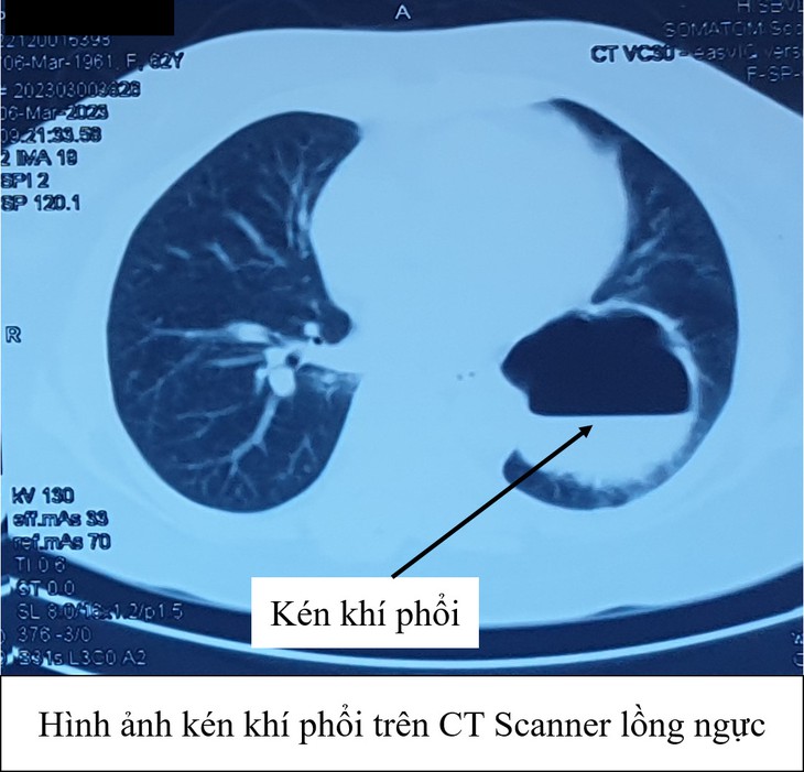 Kén khí phổi: Nguyên nhân, nhận biết và điều trị - Ảnh 1.