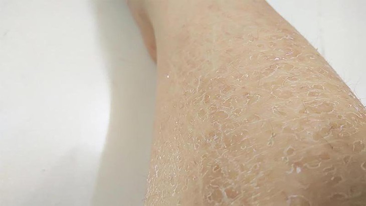 Bệnh vảy cá là một bệnh ngoài da, thường do gen di truyền gây ra. Tuy nhiên, một số người bị bệnh vảy cá thông thường do bệnh nội khoa hoặc phản ứng với thuốc. Bệnh vảy cá là một bệnh ngoài da, thường do gen di truyền gây ra. Tuy nhiên, một số người bị bệnh vảy cá thông thường do bệnh nội khoa hoặc phản ứng với thuốc.