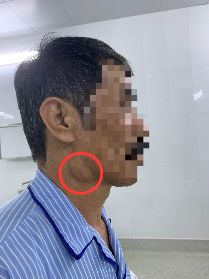 Sưng góc hàm 8 năm, đi khám người đàn ông bất ngờ bị u tuyến nước bọt - Ảnh 1.