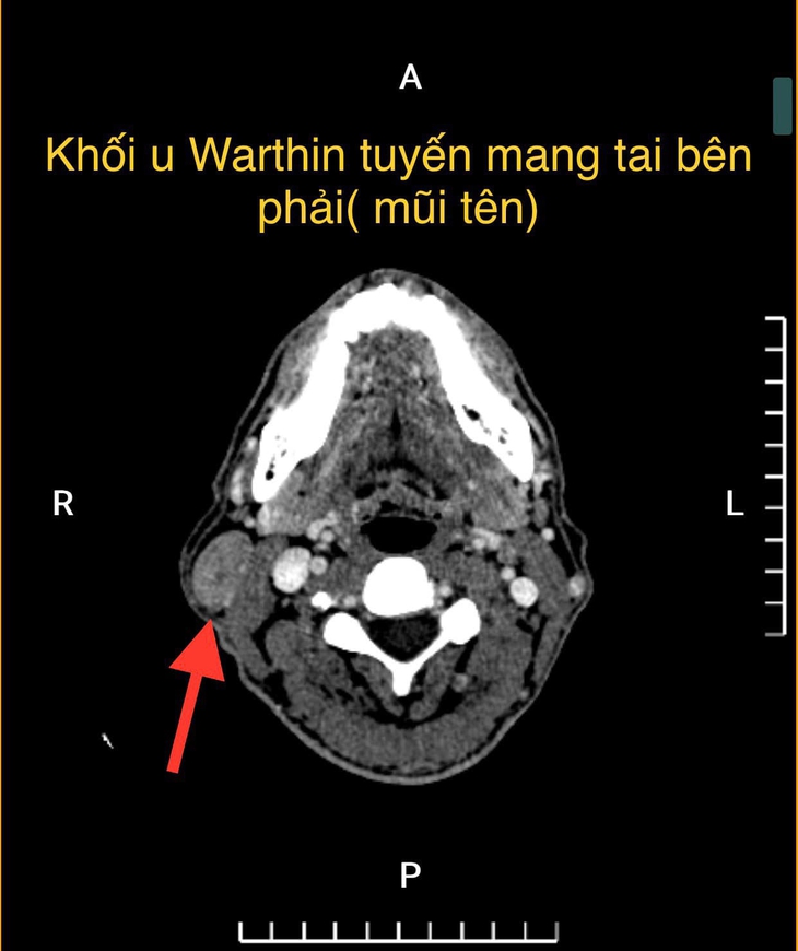 Sưng góc hàm 8 năm, đi khám người đàn ông bất ngờ bị u tuyến nước bọt - Ảnh 2.