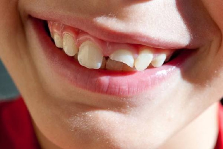 Cần làm gì khi trẻ bị ngã chấn thương răng? - Ảnh 2. Cần làm gì khi trẻ bị ngã chấn thương răng? - Ảnh 2.