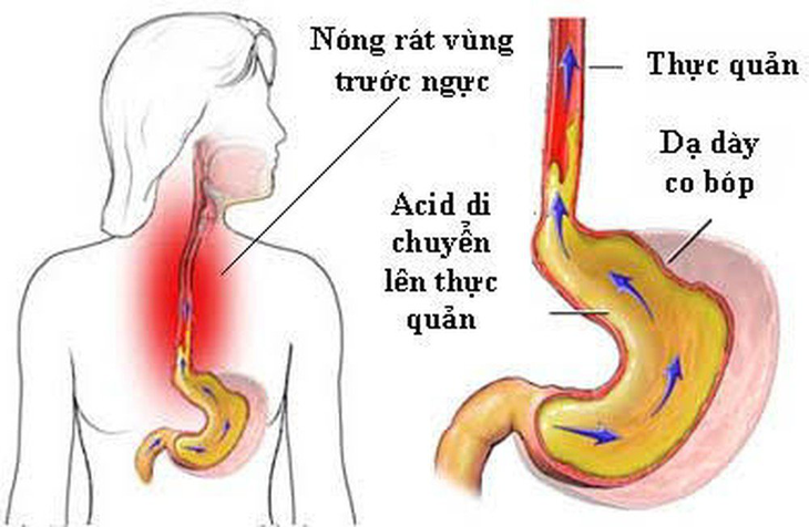 Mẹo ăn uống tốt cho người bị trào ngược dạ dày-thực quản - Ảnh 2. Mẹo ăn uống tốt cho người bị trào ngược dạ dày-thực quản - Ảnh 2.