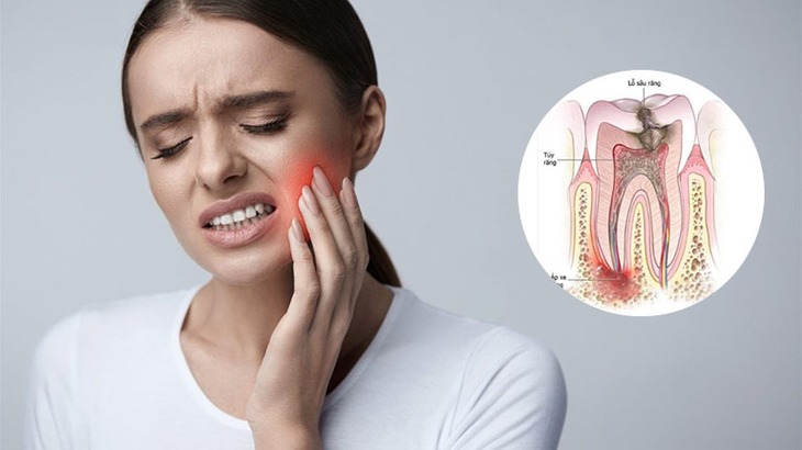 Đau răng, ê buốt thường xuyên, hơi thở hôi… thận trọng áp xe răng - Ảnh 2. Đau răng, ê buốt thường xuyên, hơi thở hôi… thận trọng áp xe răng - Ảnh 2.