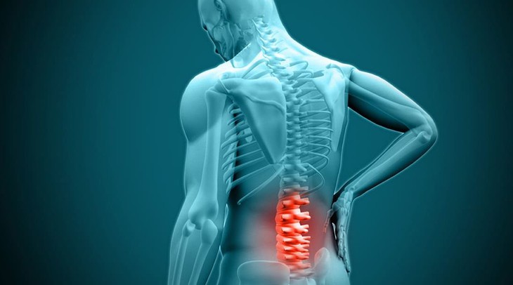 Biểu hiện của thoát vị đĩa đệm, cách điều trị hiệu quả - Ảnh 1. Biểu hiện của thoát vị đĩa đệm, cách điều trị hiệu quả - Ảnh 1.