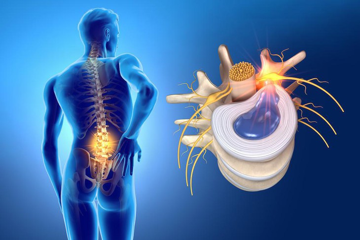 Bơi lội mùa nóng giúp giảm đau ở người bệnh thoát vị đĩa đệm cột sống - Ảnh 1. Bơi lội mùa nóng giúp giảm đau ở người bệnh thoát vị đĩa đệm cột sống - Ảnh 1.