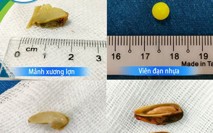Liên tiếp có trẻ nhỏ nhập viện vì hóc dị vật đường thở, chuyên gia cảnh báo nguy hiểm