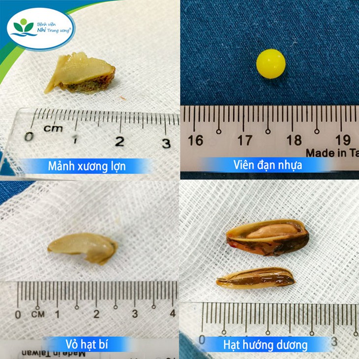 Liên tiếp có trẻ nhỏ nhập viện vì hóc dị vật đường thở, chuyên gia cảnh báo nguy hiểm - Ảnh 1.