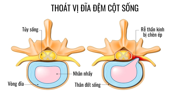 Biểu hiện của thoát vị đĩa đệm, cách điều trị hiệu quả - Ảnh 2. Biểu hiện của thoát vị đĩa đệm, cách điều trị hiệu quả - Ảnh 2.