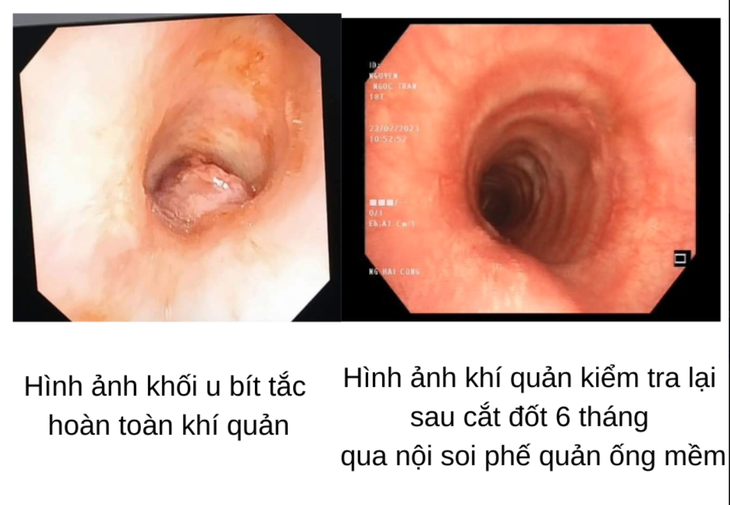 Cứu sống cô gái 17 tuổi mang khối u khí quản hiếm gặp - Ảnh 1.