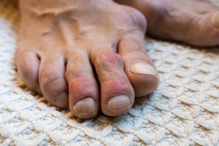 Bệnh gout có chữa được không? - Ảnh 1.