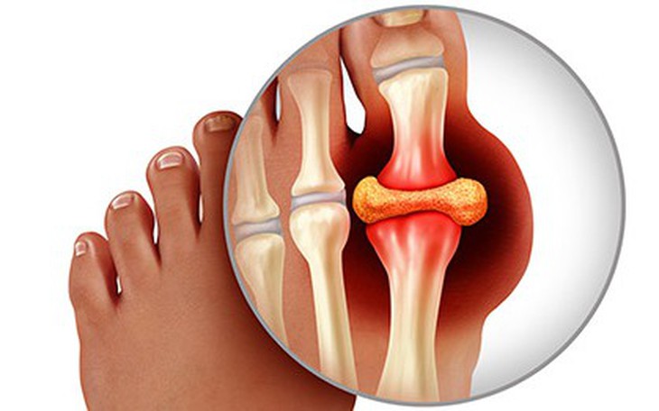 Biểu hiện của bệnh gout và cách chữa hiệu quả
