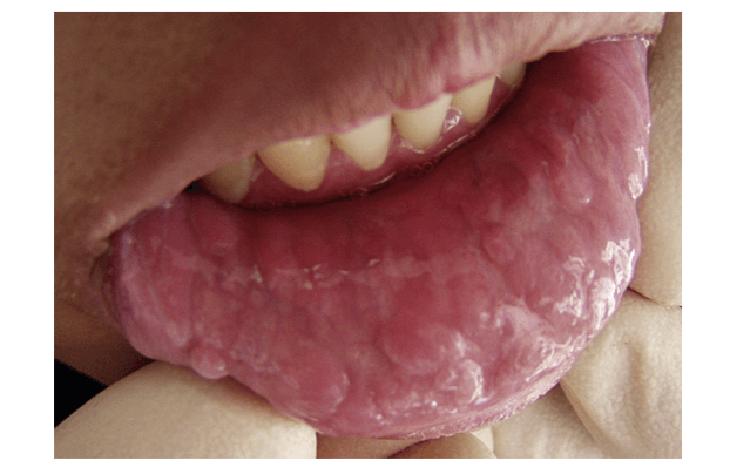 Các biểu hiện nhiễm HPV trong miệng - Ảnh 2. Các biểu hiện nhiễm HPV trong miệng - Ảnh 2.