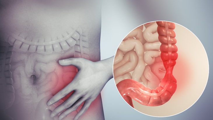Các thuốc dùng trị hội chứng ruột kích thích kèm táo bón - Ảnh 1. Các thuốc dùng trị hội chứng ruột kích thích kèm táo bón - Ảnh 1.