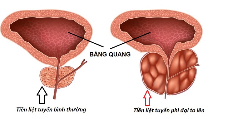 U xơ TLT có thể phát triển từ từ trong một thời gian dài mà không gây nên bất kỳ sự nguy hiểm nào.