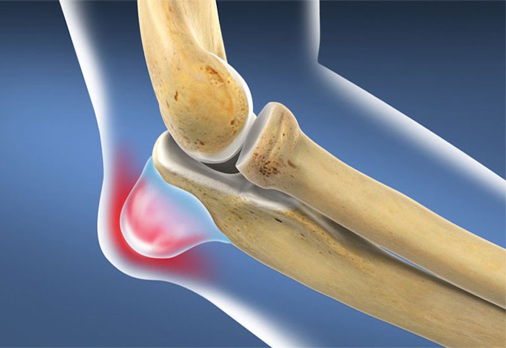 U bao hoạt dịch chân không gây nguy hiểm, có thể không điều trị cũng được.