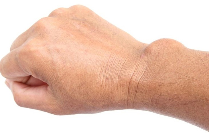 U bao hoạt dịch là tình trạng dịch bị thoát ra ở các khớp, len lỏi vào những chẽ gân ở khớp đang bị u.