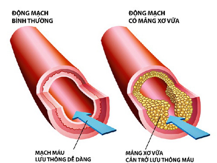 4 chìa khóa quan trọng giúp giảm mỡ máu xấu, bạn đã biết để chủ động phòng bệnh? - Ảnh 2. 4 chìa khóa quan trọng giúp giảm mỡ máu xấu, bạn đã biết để chủ động phòng bệnh? - Ảnh 2.
