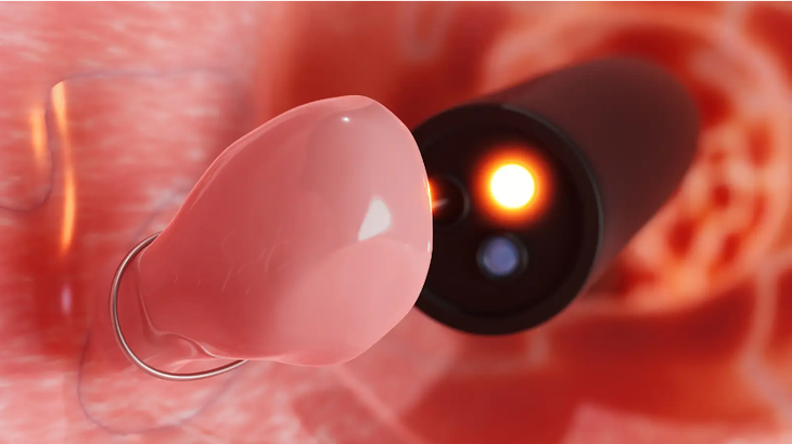 Polyp đại tràng có triệu chứng gì - Ảnh 2.