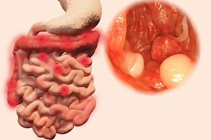 Polyp đại tràng có triệu chứng gì - Ảnh 1.