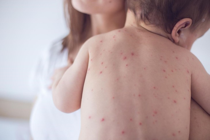 Trẻ mắc thủy đậu rồi có mắc lại không? - Ảnh 3. Trẻ mắc thủy đậu rồi có mắc lại không? - Ảnh 3.