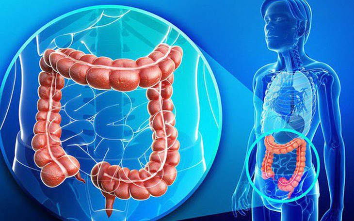 Hai chị em ruột đều mắc ung thư đại tràng, bác sĩ lý giải Hội chứng đa polyp gia đình và mối liên quan đến ung thư