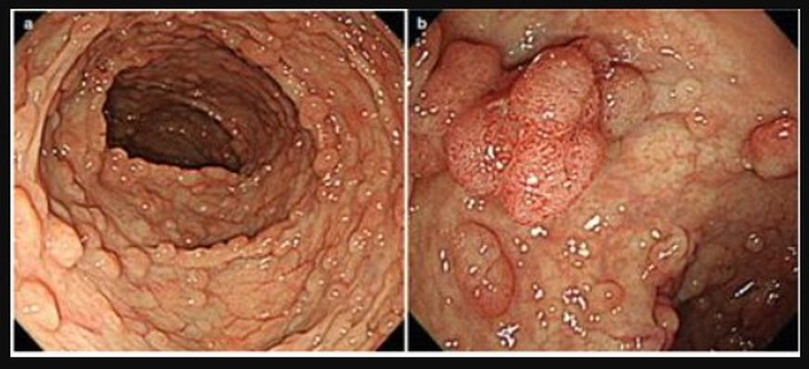 Hai chị em ruột đều mắc ung thư đại tràng, bác sĩ lý giải Hội chứng đa polyp gia đình và mối liên quan đến ung thư - Ảnh 2. Hai chị em ruột đều mắc ung thư đại tràng, bác sĩ lý giải Hội chứng đa polyp gia đình và mối liên quan đến ung thư - Ảnh 2.