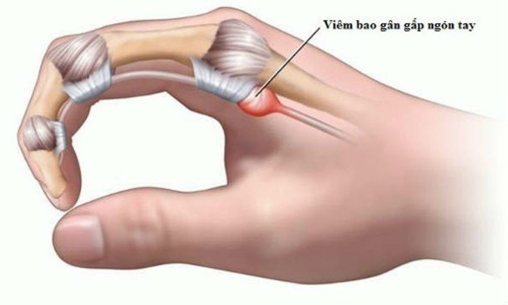 Làm việc dùng ngón tay nhiều, dễ mắc ngón tay cò súng - Ảnh 1. Làm việc dùng ngón tay nhiều, dễ mắc ngón tay cò súng - Ảnh 1.