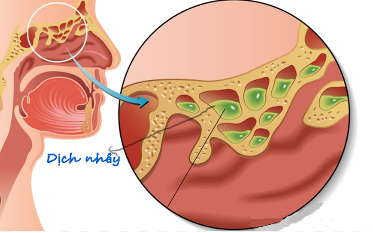 6 biện pháp tự nhiên điều trị nghẹt mũi
