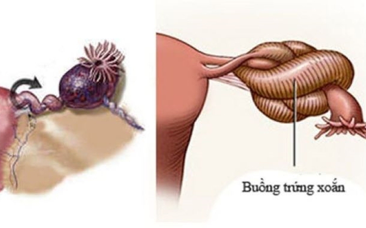 Xoắn buồng trứng hoại tử, bé 18 tháng phải cắt bỏ buồng trứng