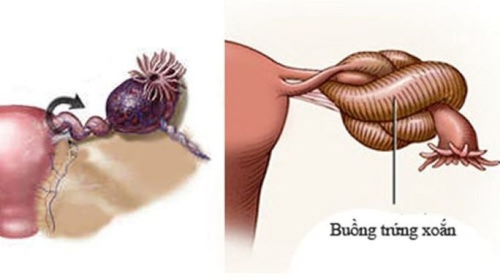 Bé gái 18 tháng tuổi phải cắt bỏ 1 buồng trứng - Ảnh 1. Bé gái 18 tháng tuổi phải cắt bỏ 1 buồng trứng - Ảnh 1.