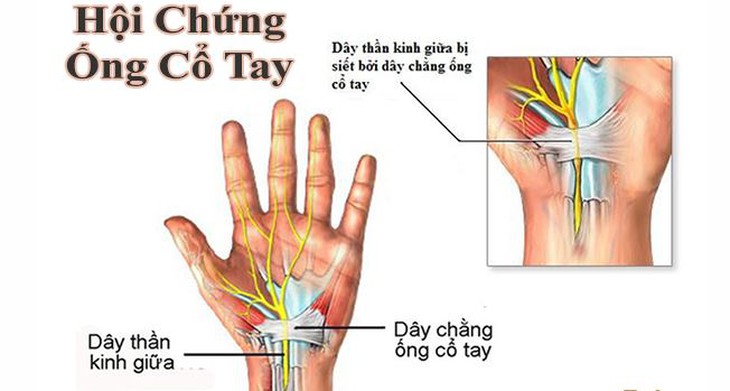 Hội chứng ống cổ tay: Nguyên nhân, biểu hiện và điều trị - Ảnh 2. Hội chứng ống cổ tay: Nguyên nhân, biểu hiện và điều trị - Ảnh 2.