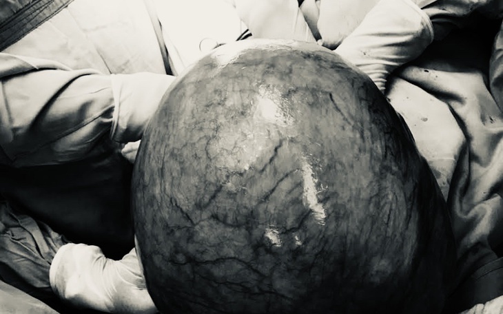 Hy hữu: Bụng to bất thường, người phụ nữ nghĩ do... béo, khi đến viện sững sờ biết có u tử cung gần 10 kg