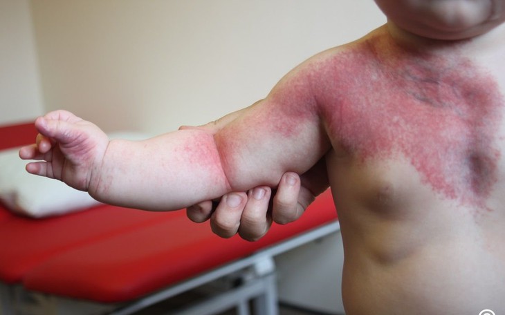 Bớt đỏ rượu vang và cách điều trị