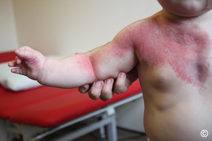 Phân biệt bớt "đỏ rượu vang" và cách điều trị - Ảnh 1.